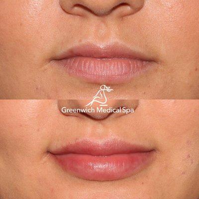 Your solution to fuller lips may include Restylane Kysse, Juvéderm Ultra XC, Volbella, or BOTOX injections.