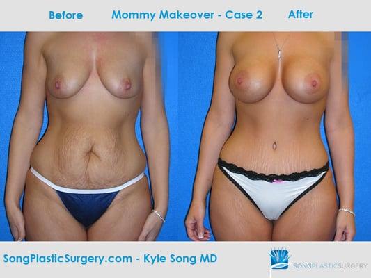 Mommy Makeover before & after: breast aug. to fill deflated breasts & tummy tuck to remove excess skin.