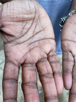 Dry, peeling hands after gel manicure