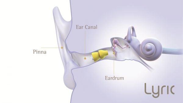 Invisible Hearing Aids (Devices) offered at our office by Doctors of Audiology.