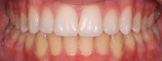 Custom Whitening