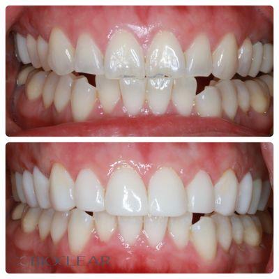 Bioclear to cover wear on teeth.