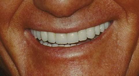 AFTER PORCELAIN VENEERS