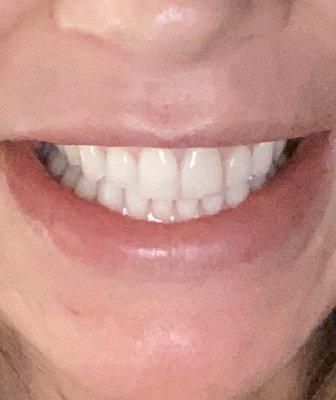 One of the front teeth is a full crown.  You can barely tell!!!!