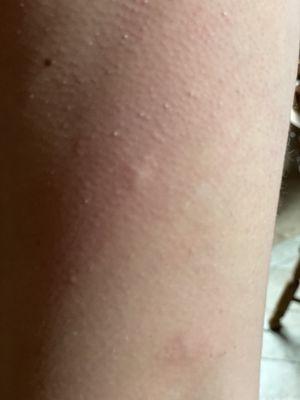 Bed bug bites