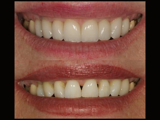 Close gaps between teeth without surgery