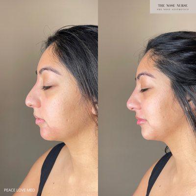 Facial balancing results achieved by strategically injecting Hyaluronic Acid based dermal filler to the Lips, Chin, and Nose!