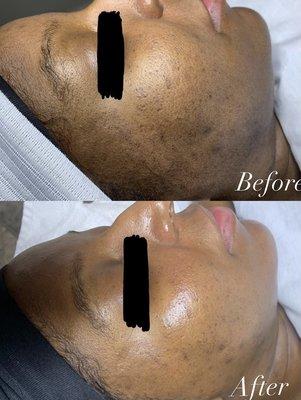 Dermaplane Facial