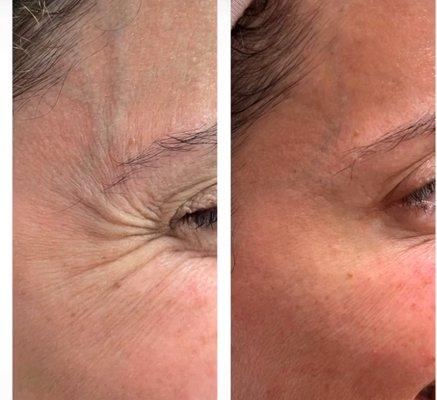 Eliminate crows feet with Botox