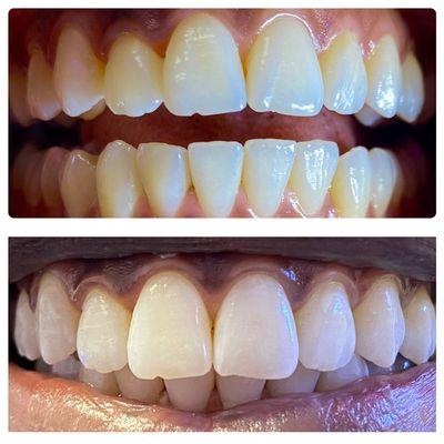 Teeth Whitening: We got this client 7 shades whiter! Book with us online or message us. www.skinetic.org