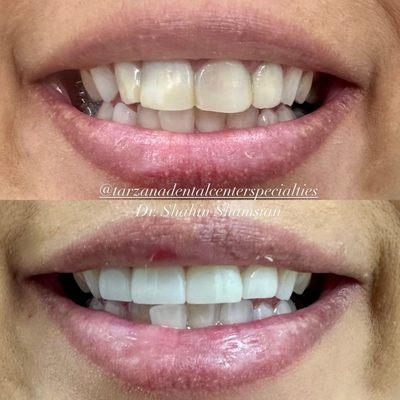 Before & After: Teeth whitening and 4 Zirconia crowns