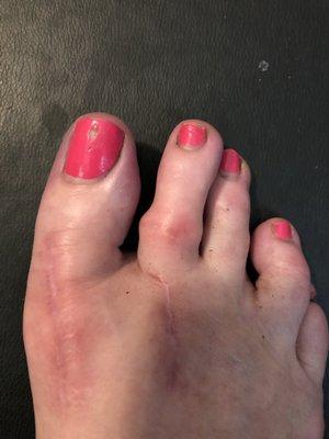 Hemi implant second toe is out of alignment causing pain a year ago