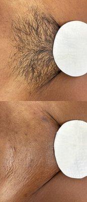 Before and after Brazilian wax