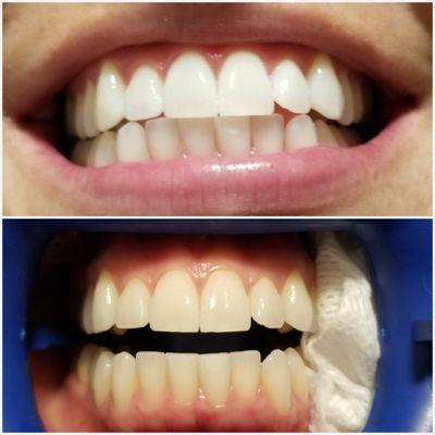 philips zoom whitening  results