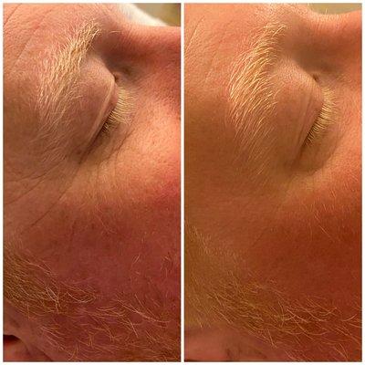 Exfoliation & hydration treatment before and after