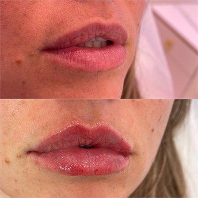 Before/After lips