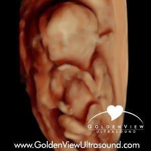 HDLive Ultrasound at 15 weeks caputured at GoldenView Ultraosund during Ultimate Gender Reveal Ultrasound