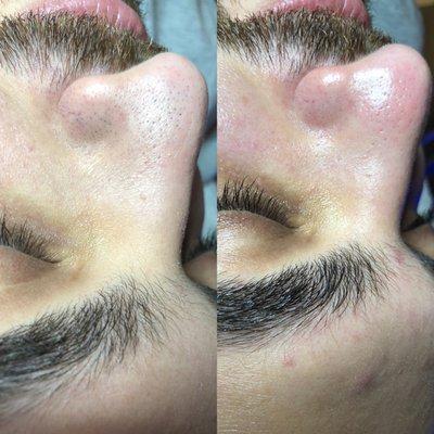 Before&After HydraFacial