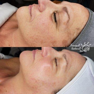 Results after 9 months of Home Care products and consistency. Microneedling, Chemical Peels, and Dermaplaning.