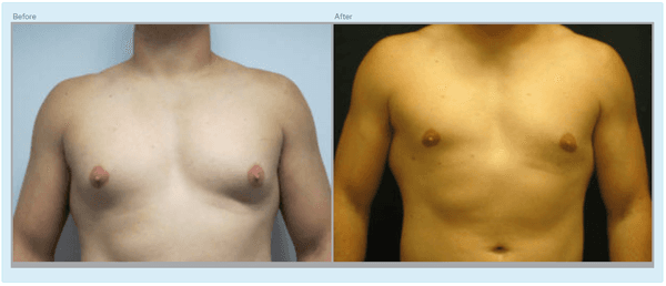 Gynecomastia: Before and After