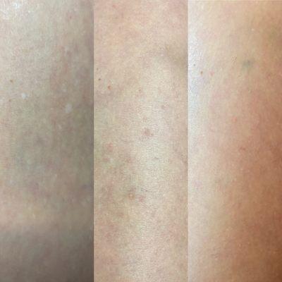 Paramedical Pigmentation - hypopigmentation concealment