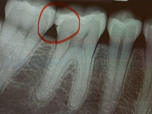 X ray done at my new dentist office showing that the filling is done incorrectly