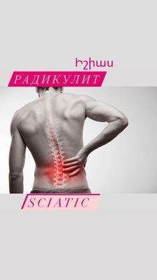 Sciatica