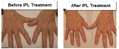 Before and After IPL Treatment