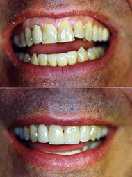 Before and after dental makeover