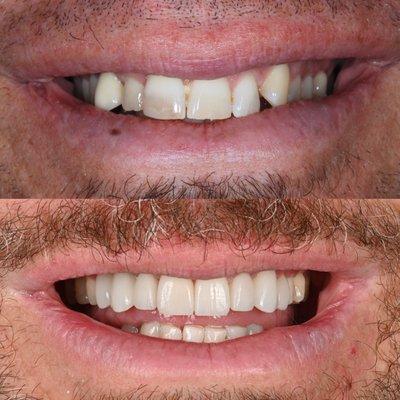 7 veneers and one implant crown to complete this beautiful smile