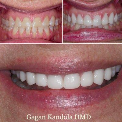 Before and After photo of Restoring teeth with crowns/Veneers.  Teeth worn-out from acid Erosion, Clenching and grinding. Smile Rejuvenation