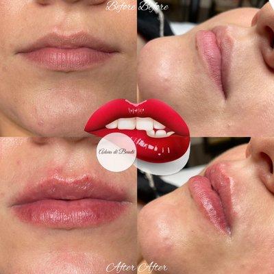 NON INVASIVE LIP FILLER (NO NEEDLES)