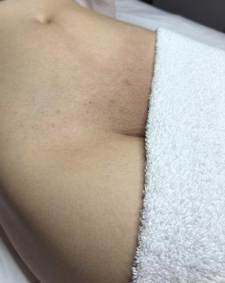 Brazilian sugar waxing