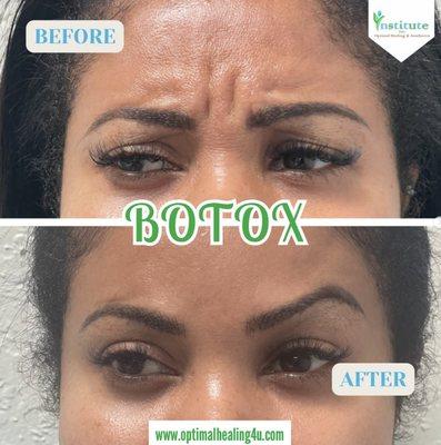 Botox treatments in Oakland Park Fort Lauderdale.