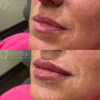 Lip augmentation using filler done by nurse Shannon