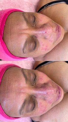 Close up before (top) & after (bottom) ONE micro needling session. 3 treatments are recommended for best results.