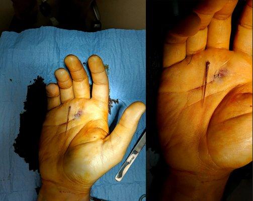 Thank you Dr. for taking this huge thorn out of my hand professionally. You are Amazing!