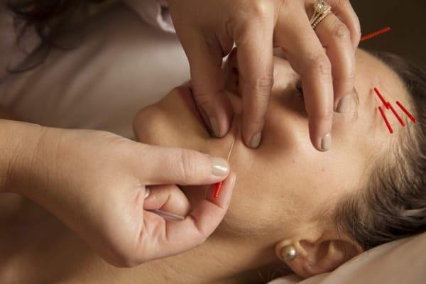 Cosmetic Acupuncture