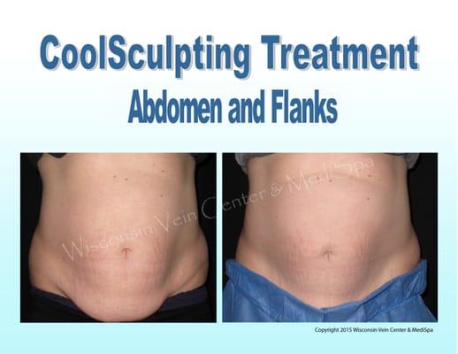 WVCMS offers CoolSculpting for pinchable fat, CoolSmooth for outer thighs, & DualSculpting to cut treatment time in half!