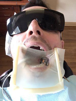 Cool sunglasses :) And a mouth guard to ensure no bacteria gets anywhere near the root canal