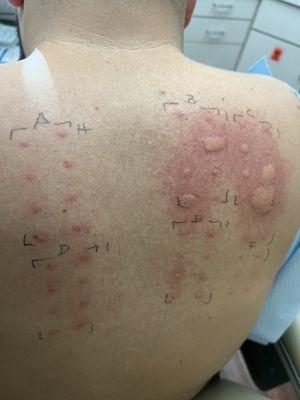 Allergy test