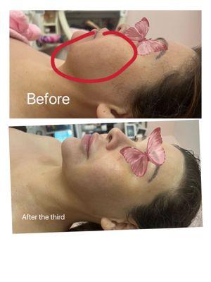 Get rid of the unwanted fat cells, and see  beautiful defined jawline!