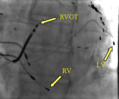 Fluoroscopic images of Cardiac Resynchronization Therapy (CRT), the so-called "biventricular defibrillator"