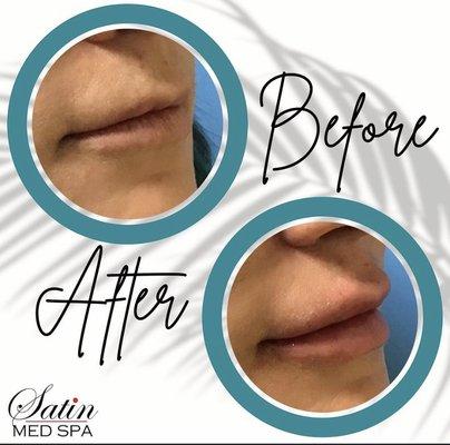 Subtle volume added to lips makes thin lips turn into full & sexy lips!