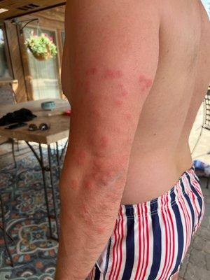 Bed bug bites