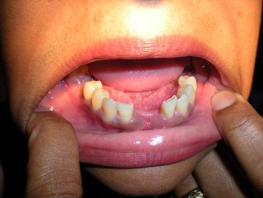 BEFORE photo of patient (957) with missing teeth on the lower jaw.