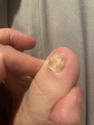 Damaged big toe