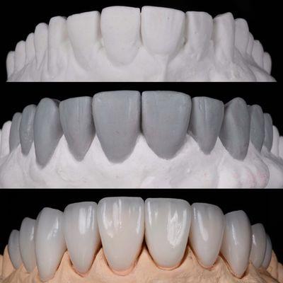 The finest veneers