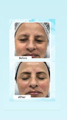 radiofrequency and henna eyebrows