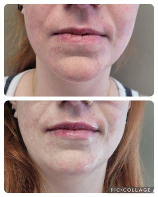 Lip Filler: Before & After